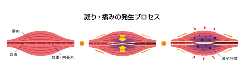 筋肉の緊張から血行不良、それに伴う筋肉疲労