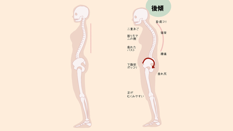 お尻が垂れる原因③ 骨盤の歪み